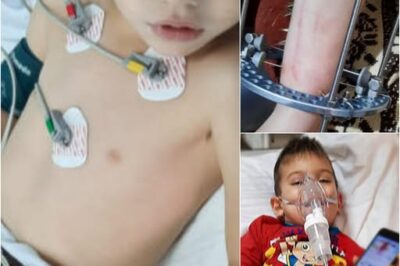 “A Little Boy’s Brave Battle Against Pseudarthrosis”